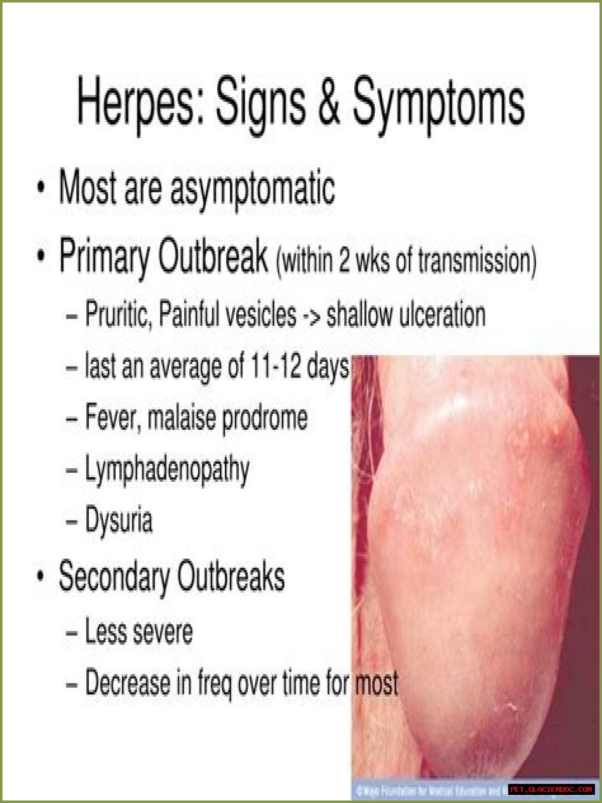 Is Herpes Contagious all the time?